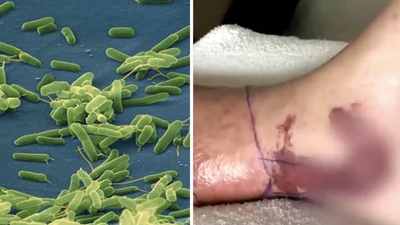 Alertan por bacteria come carne en Florida tras aumento temprano de infecciones