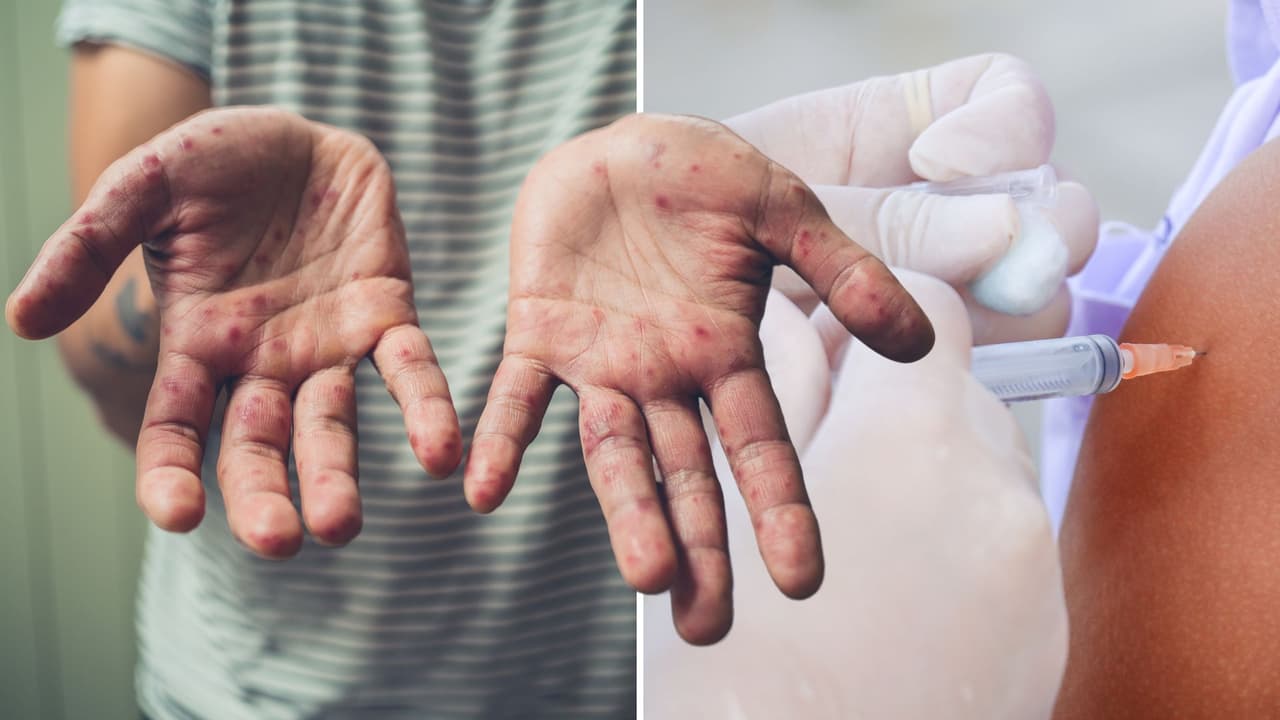 Texas al borde de los 200 casos de sarampión: Un brote que sigue avanzando, ¿cómo proteger a tu familia?