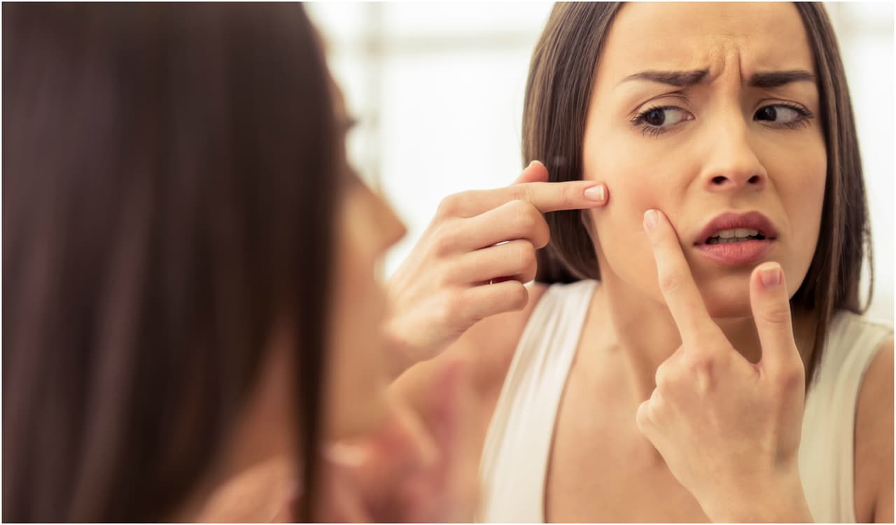 Una especialista te dice cómo debes atenderte el acné y por qué no debes pellizcarte el rostro