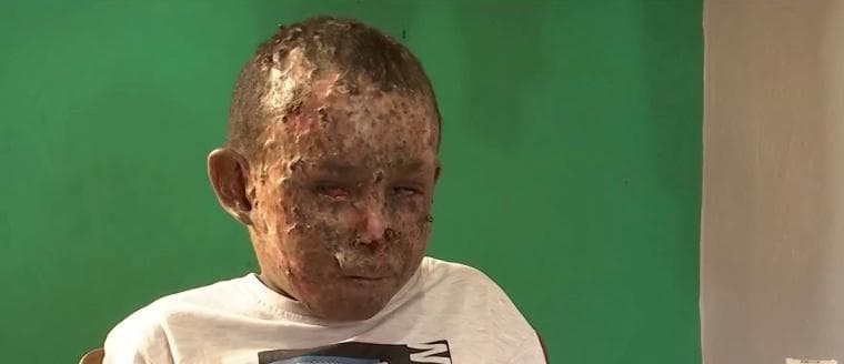Mariano González tiene 10 años y nunca ha podido conocer el mar pese a que nació en una ciudad con playas frente al Caribe, Anzóatequi en
<a href="https://www.univision.com/temas/venezuela">Venezuela</a>.
<b>La razón: los rayos ultravioleta del sol le afectan extremadamente en la piel y ojos desde los 6 meses de edad.</b>
<br>
