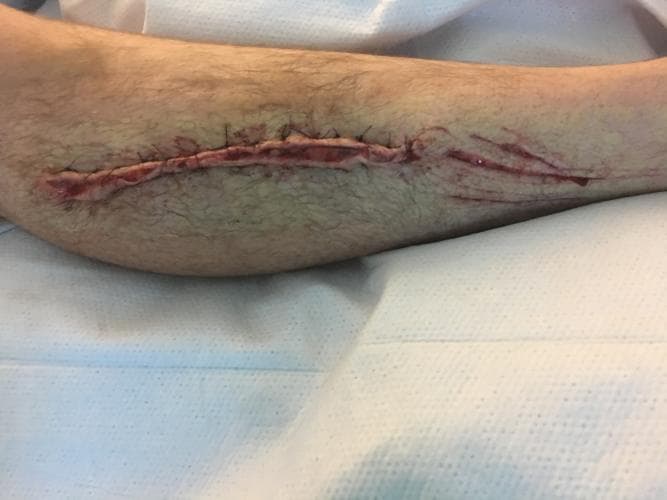 Bowden tuvo que ser sometido a una cirugía, porque el tiburón que lo atacó le arrancó un pedazo de músculo. Al salir del hospital, el hombre dijo que se sentía agradecido de estar vivo y que le pensaba dar un descanso al mar.