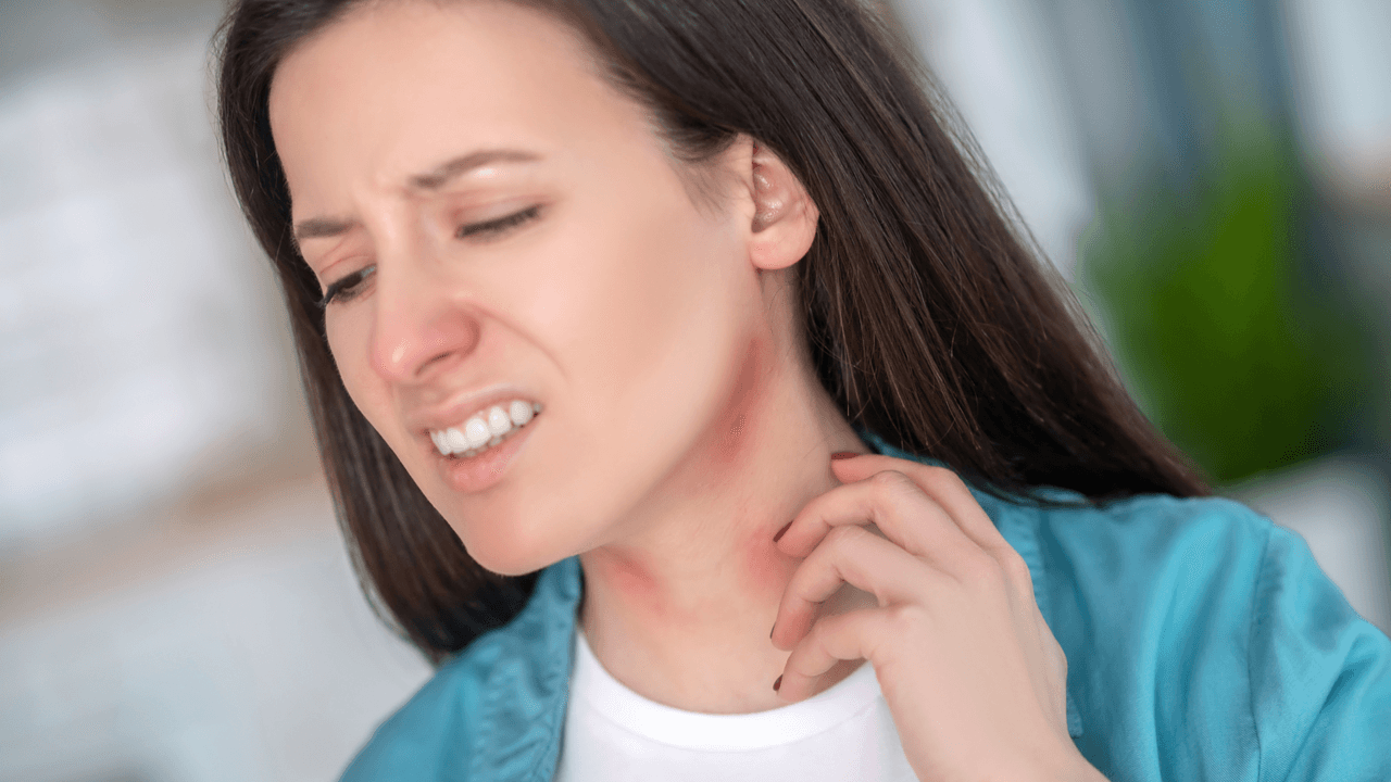 ¿Cómo combatir la urticaria? 5 remedios caseros que calman la picazón intensa