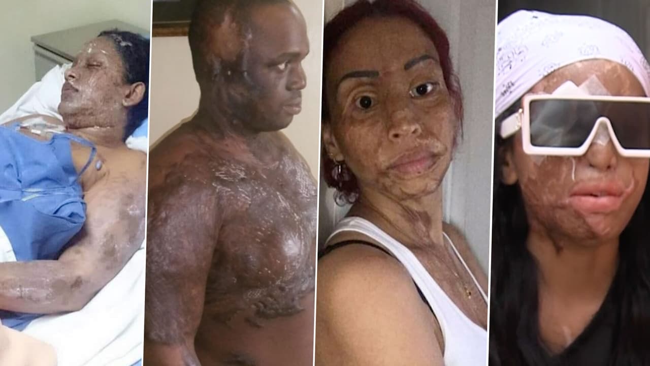 Ácido del diablo: las historias de víctimas atacadas en República Dominicana