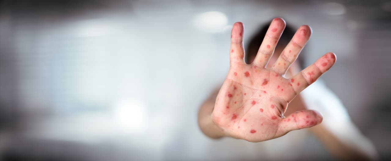 Todos los pacientes en Utah
<b>son personas no vacunadas</b>. La vacuna es la forma más eficaz de prevenir la enfermedad, destacan las autoridades sanitarias.