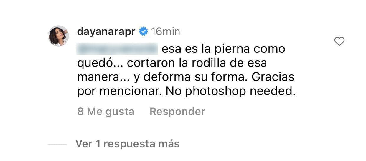 Dayanara Torres se defendió:
<b> "Esa es la pierna como quedó"</b>, le explicó, "cortaron la rodilla de esa manera… y deforma su forma".
<br>