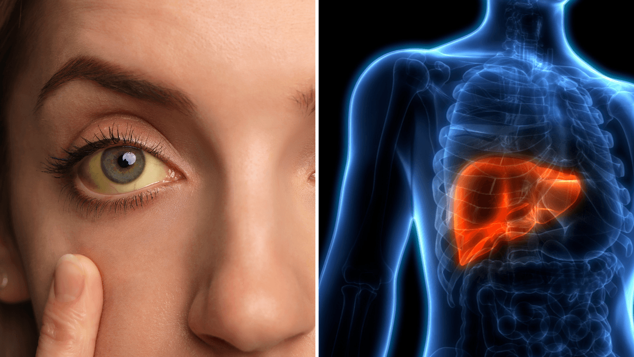 Los síntomas de hígado graso también aparecen en la piel: 4 señales para darte cuenta