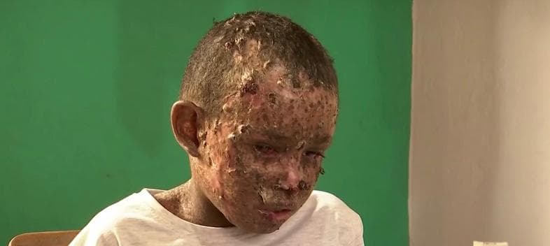 En busca de un tratamiento para el padecimiento,
<b>la familia y el pequeño viajaron a Colombia, en donde los doctores le diagnosticaron xerodermia pigmentosa</b>, una rara
<a href="https://www.univision.com/temas/enfermedad">enfermedad</a> genética.
<br>