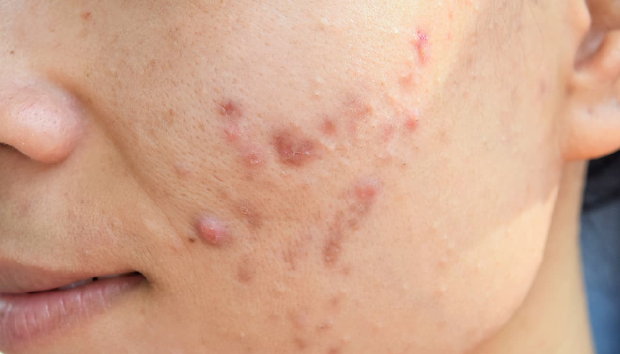 Tu ropa te está sacando espinillas y no lo sabías: conoce el acné mecánico