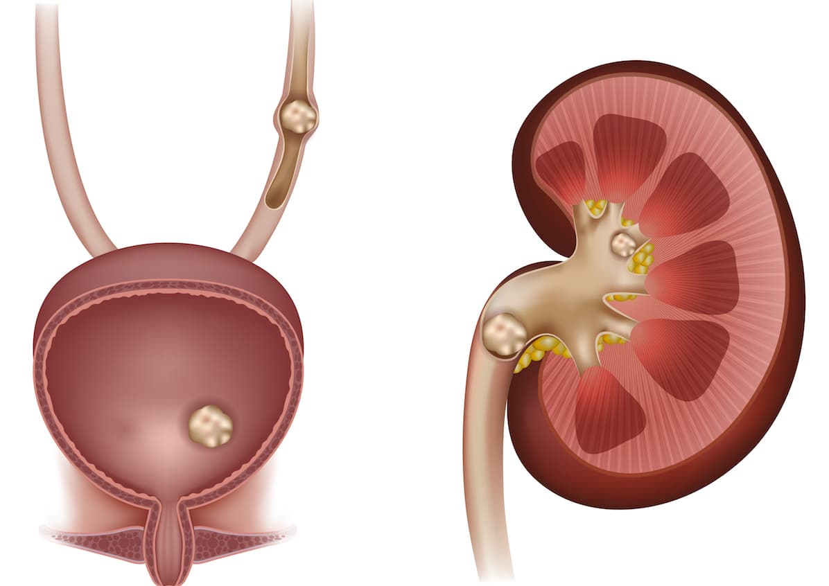 ¿Por qué se forman las piedras en el riñón que llevaron al hospital a Belinda?