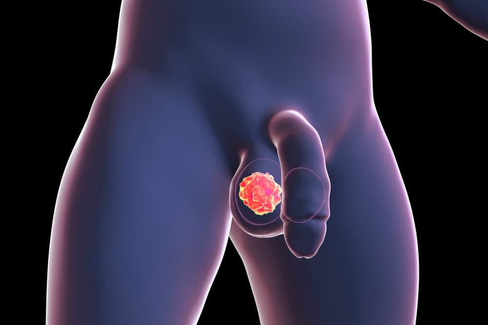 Síntomas de cáncer testicular que no se limitan a sentir un bulto