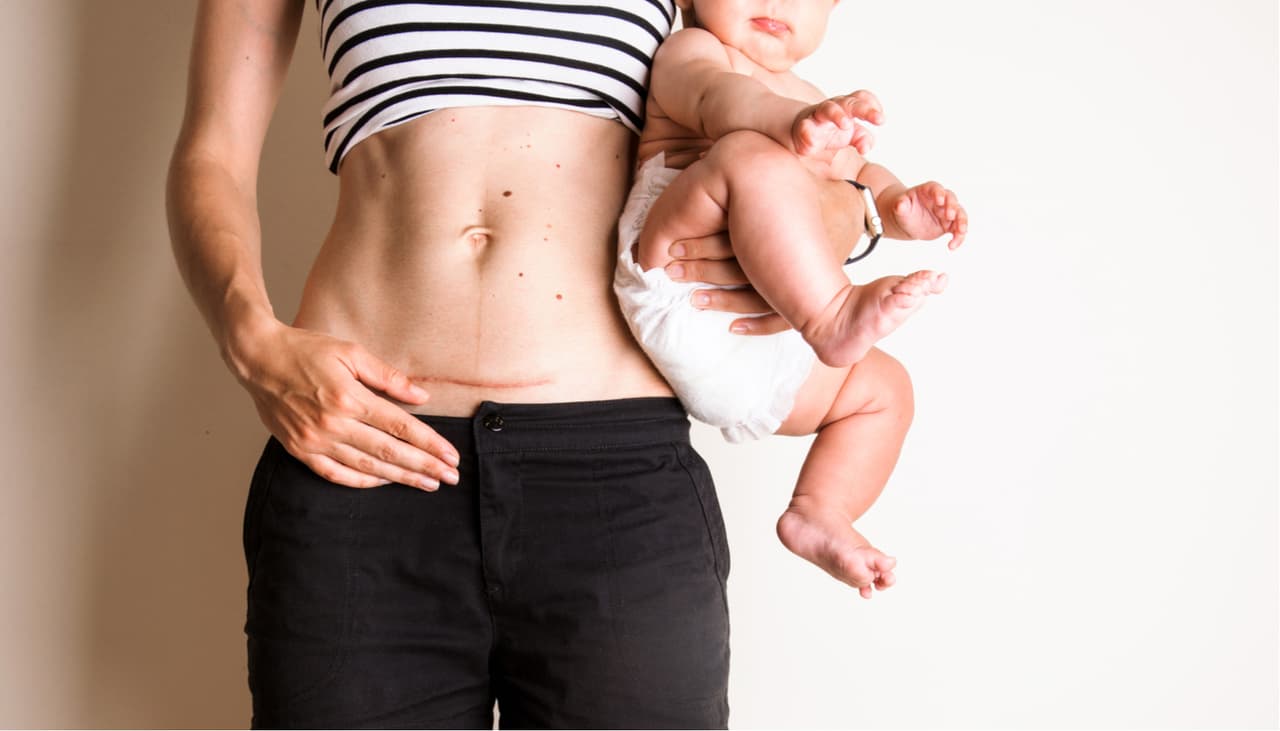 6 cosas que le pasarán a tu cuerpo luego de la cesárea y nadie te advirtió