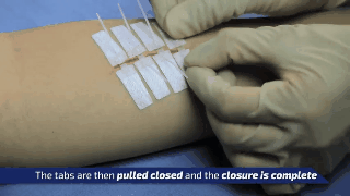 ¿Odias las agujas? Así se podrán cerrar las heridas en el futuro