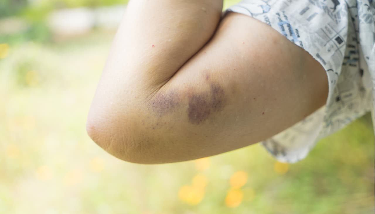 ¿Te aparecen moretones con frecuencia y sin razón aparente? Pueden ser señal de una enfermedad