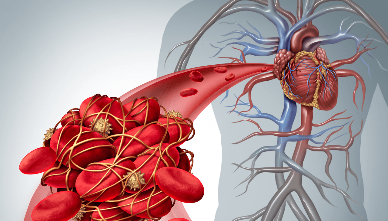 La trombosis tiene 4 síntomas fáciles de detectar y que podrían salvar tu vida