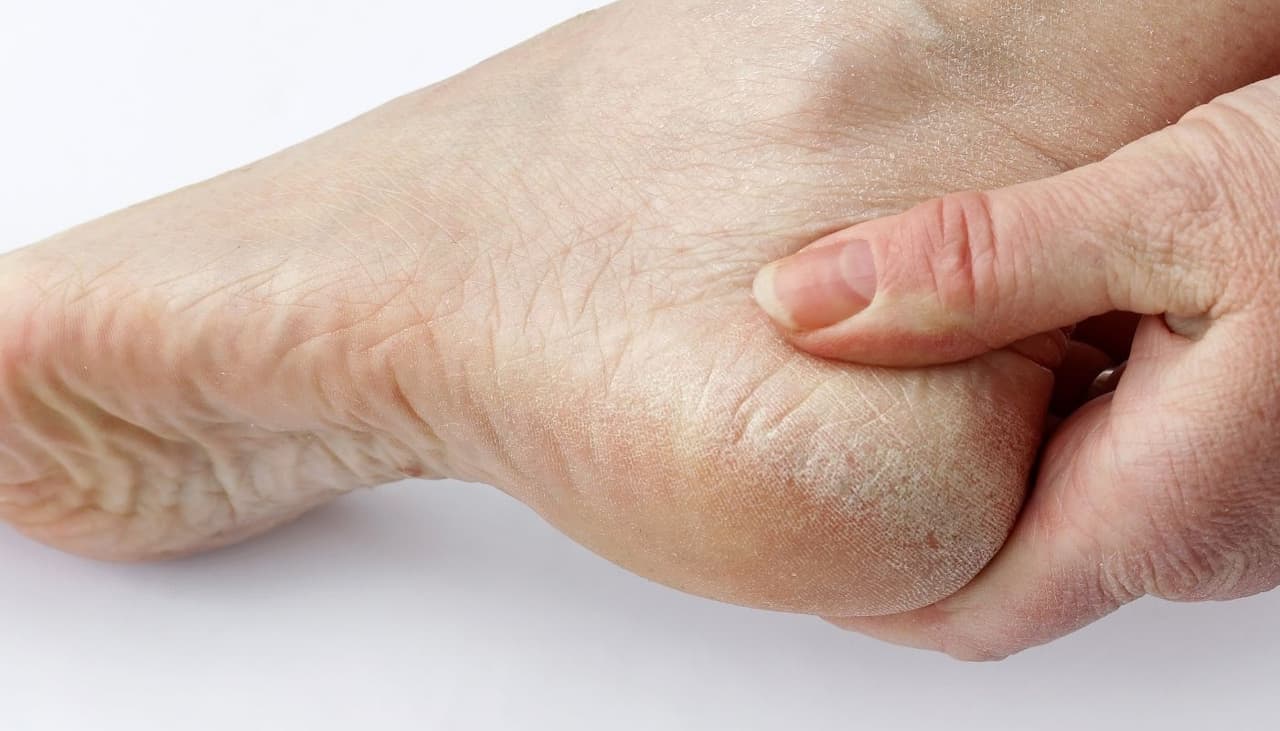 Evita lesiones y camina mejor: tener callos puede ser lo mejor para tus pies