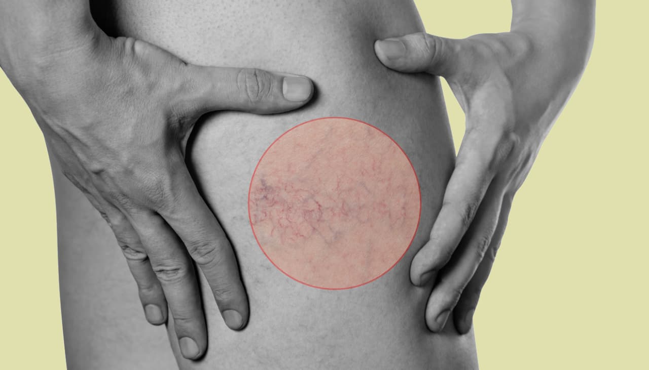 Tratamiento para várices: 8 claves que resuelven el tema de una vez por todas